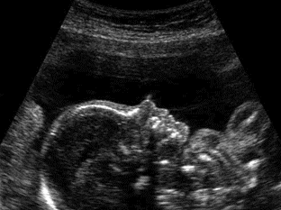 chographie obsttricale du premier trimestre de la grossesse